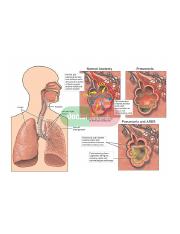 ARDS & Pneumonia.jpg