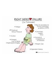 Right Sided Heart Failure mnemonic notes