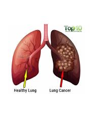 lung-cancer-vs-normal-lung.jpg