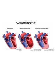 cardiomyopathy-chart.jpg