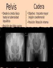 Diferencia de fractura de pelvis y de cadera [Autoguardado].pptm