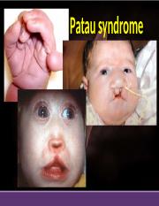 Syndrome patau Trisomy 13